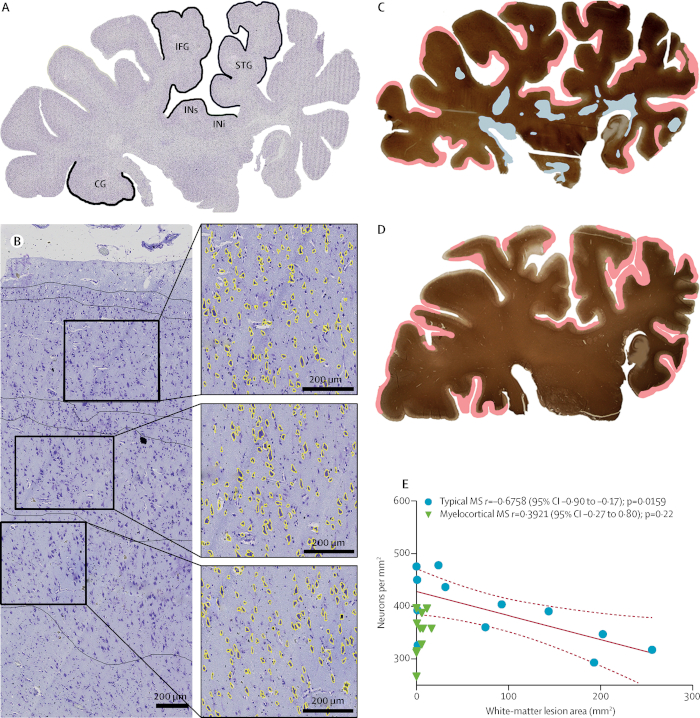 Comprehensive Autopsy Program for Individuals with Multiple Sclerosis