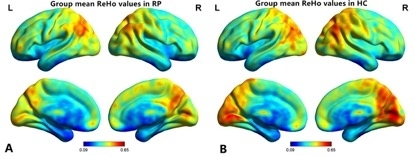 Reorganization of early visual cortex functional connectivity following  selective peripheral and central visual loss