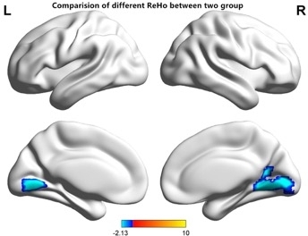 Mapping Regional Homogeneity and Functional Connectivity of the