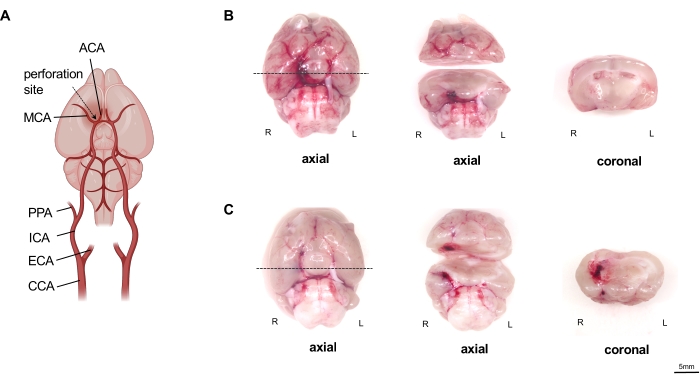 pterygopalatin sütür