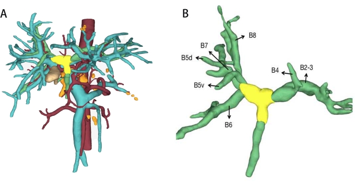 Robotic Taj Mahal Hepatectomy for Hilar Cholangiocarcinoma