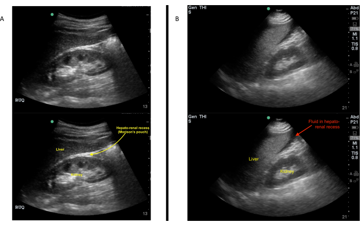 PDF] The FAST and E-FAST in 2013: trauma ultrasonography: overview,  practical techniques, controversies, and new frontiers.