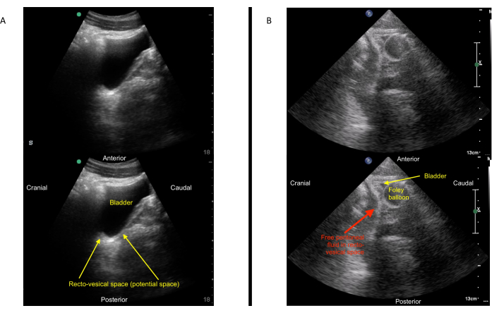 Rectouterine pouch, Radiology Reference Article